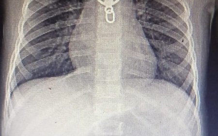 മൂന്ന് വയസുകാരി ലോക്കറ്റ് വിഴുങ്ങി; അന്നനാളത്തിന് മുകളിൽ കുടുങ്ങിയ ലോക്കറ്റ് പുറത്തെടുത്തു.