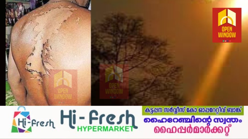 ഇടുക്കി വാഴത്തോപ്പിൽ യുവാവിനു
സൂര്യാതപമേറ്റു