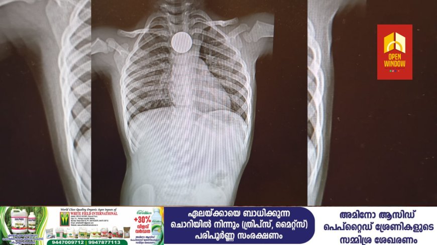 പിഞ്ചുകുഞ്ഞ് അബദ്ധത്തിൽ വിഴുങ്ങിയ നാണയം പാലാ മാർ സ്ലീവാ മെഡിസിറ്റിയിൽ നടത്തിയ ചികിത്സയിൽ പുറത്തെടുത്തു