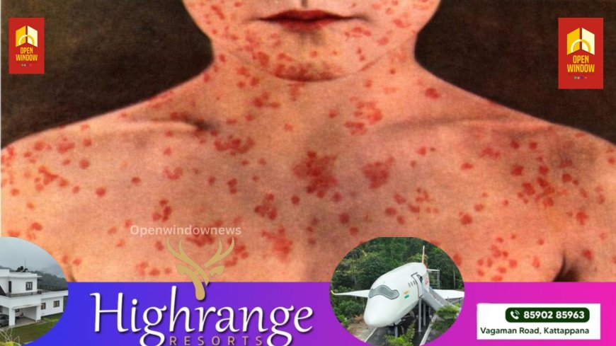 *ചിക്കന്‍പോക്‌സ്:  ലക്ഷണങ്ങള്‍ കണ്ടാലുടന്‍ ചികിത്സ തേടണമെന്ന് ആരോഗ്യ വകുപ്പ്*