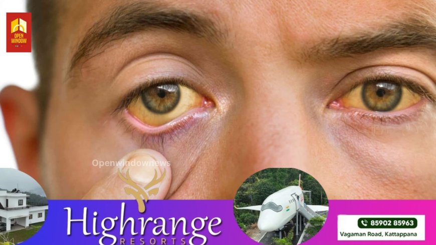 മഞ്ഞപ്പിത്തം: ജാഗ്രത പുലര്‍ത്തണമെന്ന് ആരോഗ്യവകുപ്പ്