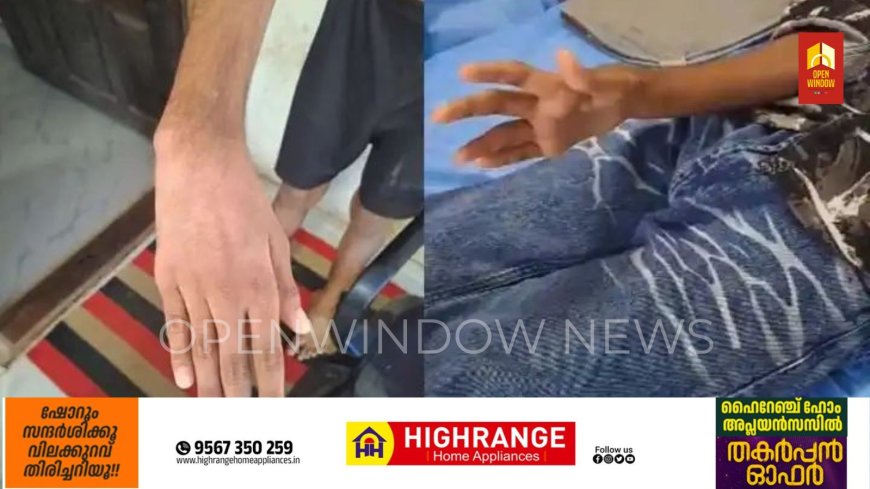 കൈ തനിയെ നേരെ ആയിക്കോളും; കോന്നിയിലേത് ചെറിയ സാധാരണ മെഡിക്കല്‍ കോളേജ്; ചികിത്സ പിഴവില്‍ വിചിത്ര വിശദീകരണവുമായി സൂപ്രണ്ട്